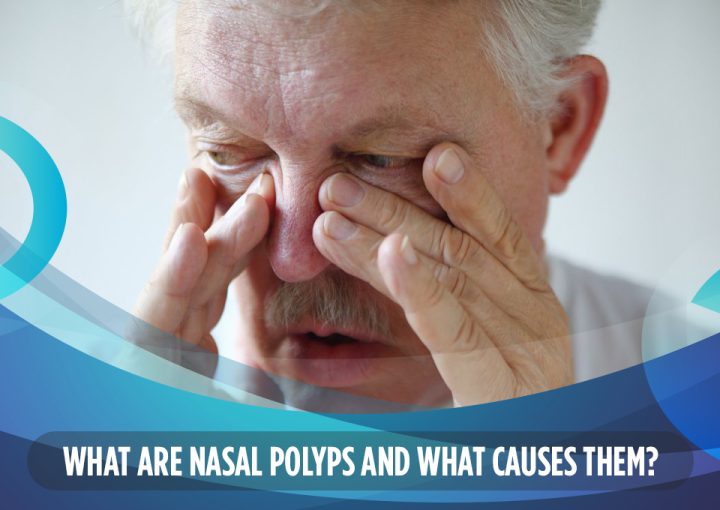 What Are Nasal Polyps and What Causes Them?