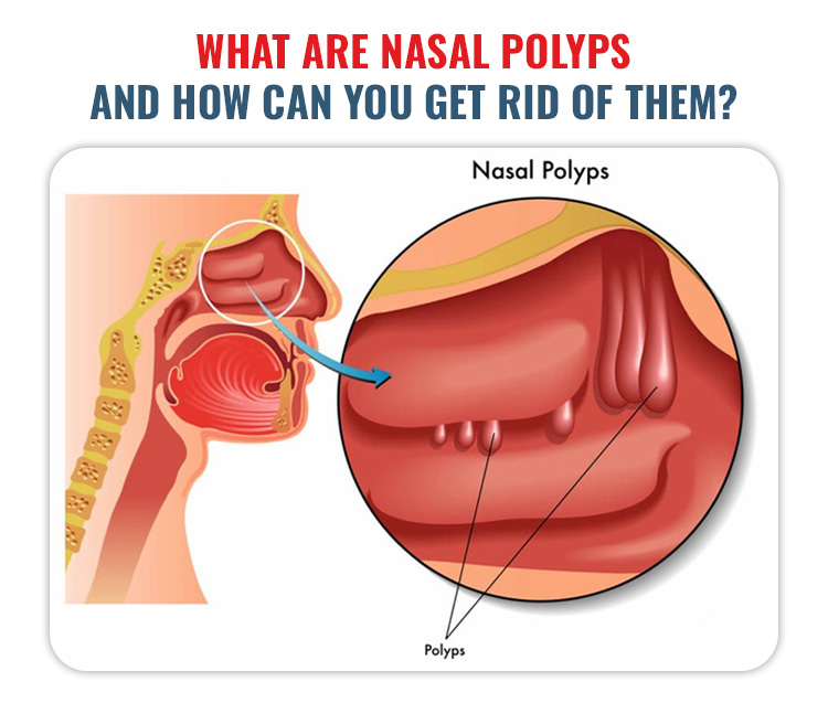 Nasal Polyps