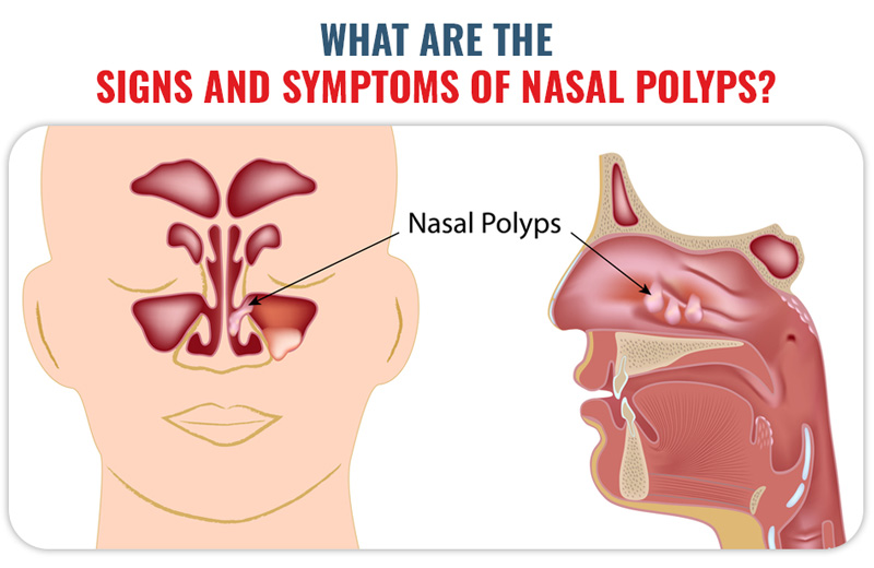 What Are The Signs And Symptoms Of Nasal Polyps