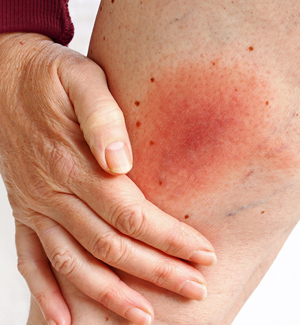 Wandering flush Lyme borreliosis